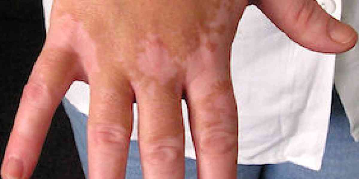 La vitiligine, male della pelle che fa male pure all’animo